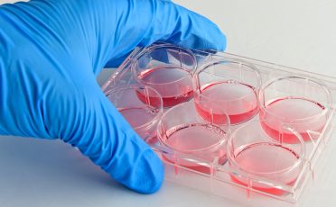Interview: humanes Thrombozytenlysat als validierter Ersatz für tierisches Serum zur Beurteilung der Chemosensitivität